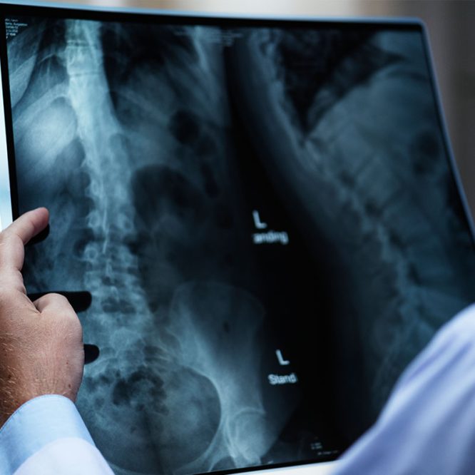 Endoskopik Omurga, Endoskopik Omurga Cerrahisi, Endoskopik omurga ameliyatı, Endoskopik bel fıtığı ameliyatı, Endoskopik boyun fıtığı ameliyatı, Endoskopik kanal daralması ameliyatı, Minimal invaziv omurga cerrahisi, Omurga cerrahisi yöntemleri, Omurga ameliyatı endoskopik teknik, Bel fıtığı endoskopik tedavi, Boyun fıtığı endoskopik tedavi, Spinal endoskopik cerrahi, Endoskopik omurga cerrahisi uzmanı, Endoskopik omurga cerrahisi doktoru, En İyi Endoskopik omurga cerrahisi uzmanı, En İyi Endoskopik omurga cerrahisi doktoru, En İyi Endoskopik cerrahi Doktoru, En İyi Endoskopik cerrahi Uzmanı