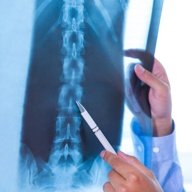 Endoskopik Omurga, Endoskopik Omurga Cerrahisi, Endoskopik omurga ameliyatı, Endoskopik bel fıtığı ameliyatı, Endoskopik boyun fıtığı ameliyatı, Endoskopik kanal daralması ameliyatı, Minimal invaziv omurga cerrahisi, Omurga cerrahisi yöntemleri, Omurga ameliyatı endoskopik teknik, Bel fıtığı endoskopik tedavi, Boyun fıtığı endoskopik tedavi, Spinal endoskopik cerrahi, Endoskopik omurga cerrahisi uzmanı, Endoskopik omurga cerrahisi doktoru, En İyi Endoskopik omurga cerrahisi uzmanı, En İyi Endoskopik omurga cerrahisi doktoru, En İyi Endoskopik cerrahi Doktoru, En İyi Endoskopik cerrahi Uzmanı