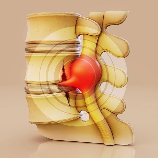 Endoskopik Omurga, Endoskopik Omurga Cerrahisi, Endoskopik omurga ameliyatı, Endoskopik bel fıtığı ameliyatı, Endoskopik boyun fıtığı ameliyatı, Endoskopik kanal daralması ameliyatı, Minimal invaziv omurga cerrahisi, Omurga cerrahisi yöntemleri, Omurga ameliyatı endoskopik teknik, Bel fıtığı endoskopik tedavi, Boyun fıtığı endoskopik tedavi, Spinal endoskopik cerrahi, Endoskopik omurga cerrahisi uzmanı, Endoskopik omurga cerrahisi doktoru, En İyi Endoskopik omurga cerrahisi uzmanı, En İyi Endoskopik omurga cerrahisi doktoru, En İyi Endoskopik cerrahi Doktoru, En İyi Endoskopik cerrahi Uzmanı